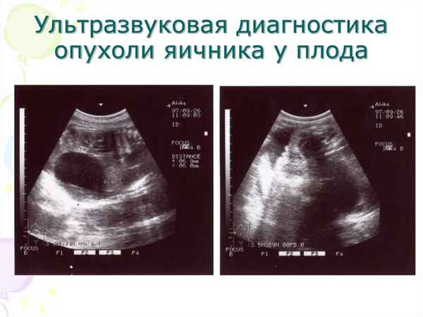 Морфология яичников у плодов и новорожденных при патологии беременности