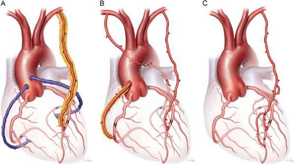 INDEXES GAS STRUCTURE VENOUS OF A BLOOD AT CEREBRAL VIOLATIONS AT THE PATIENTS AFTER CORONARY ARTERY BYPASS GRAFTING