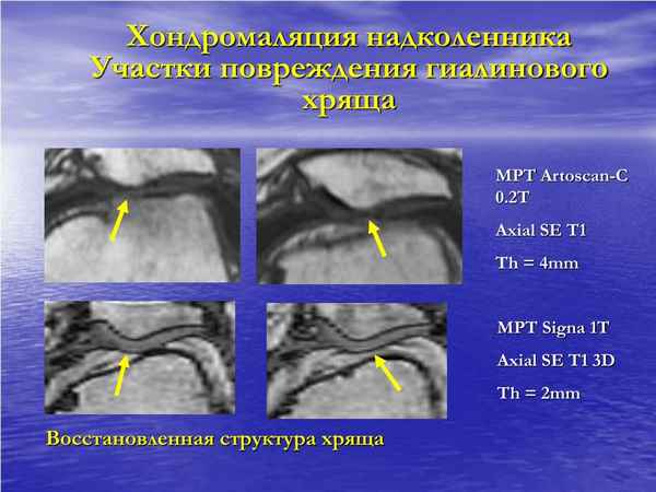 Использование магниторезонансной томографии для высокоточной комплексной неинвазивной диагностики повреждений суставного гиалинового хряща