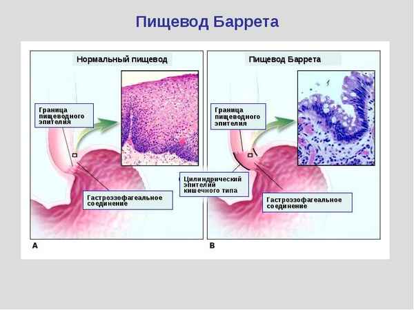 Пролиферативная активность и апоптоз эпителиоцитов пищевода при гастроэзофагеальной рефлюксной болезни и пищеводе Баррета