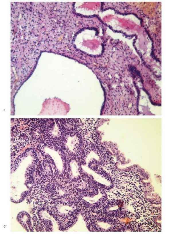 Морфогенез аденоматозной гиперплазии и плоскоклеточной метаплазии при идиопатическом фиброзирующем альвеолите