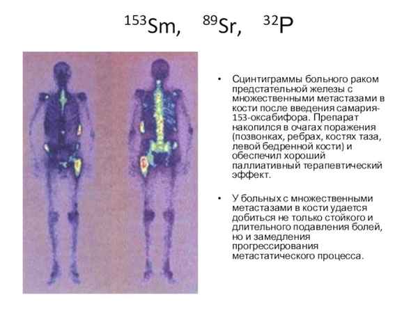 Радионуклидная терапия самарием-оксабифором, 153Sm при метастазах в кости и ревматических заболеваниях