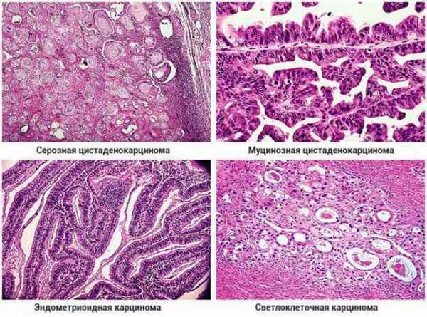 Экспрессия белка ВАХ в тканях серозного paка яичников